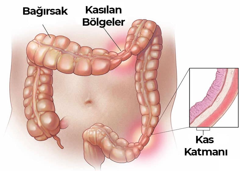 İrritabl Bağırsak Sendromu