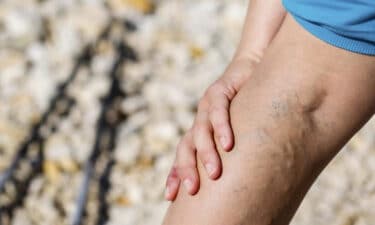 Damar Sertliği Nedir? Arteriyoskleroz / Ateroskleroz Belirtileri ve Nedenleri
