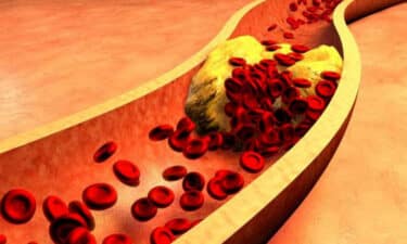 Damar Sertliği Nedir? Arteriyoskleroz / Ateroskleroz Tedavisi ve Teşhisi