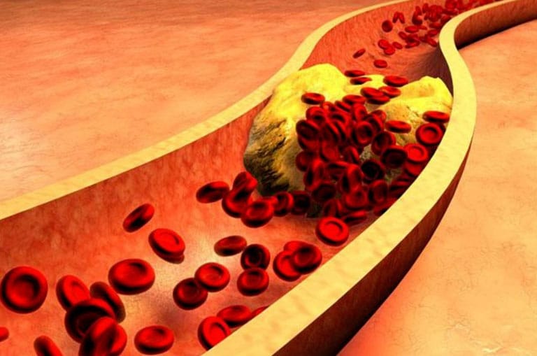 Damar Sertliği Nedir? Arteriyoskleroz / Ateroskleroz Tedavisi ve Teşhisi