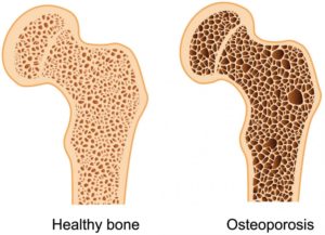 Osteoporoz