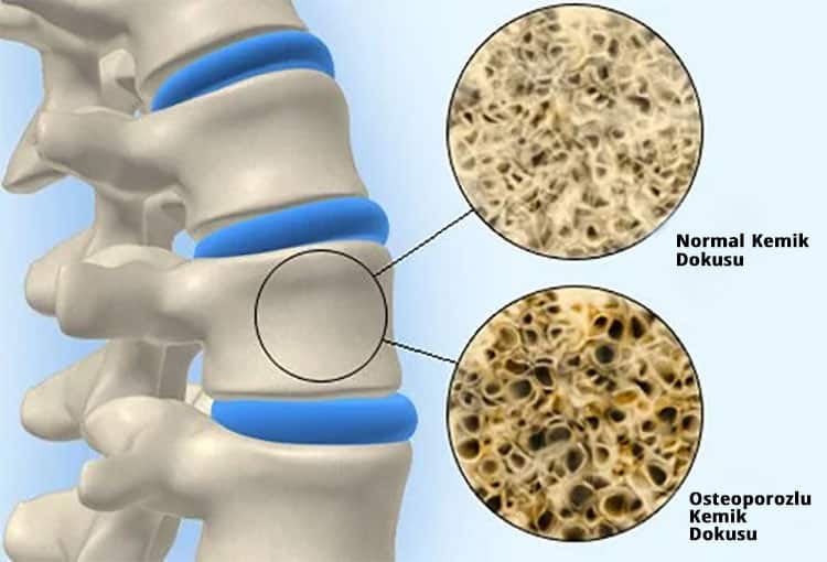 Osteoporoz