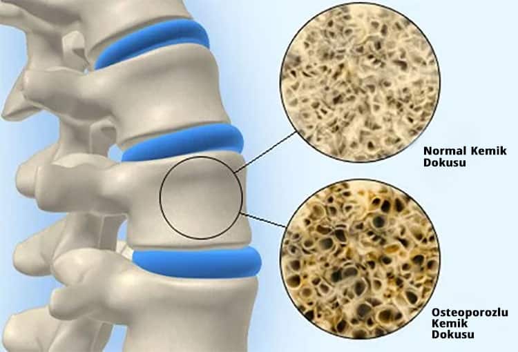 Kemik Erimesi - osteoporoz