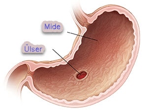 peptik ülser