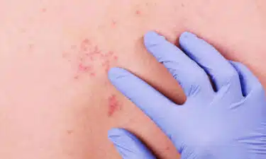 Zona Hastalığı (Herpes Zoster) Nedir? Zona Hastalığı Belirtileri ve Tedavisi