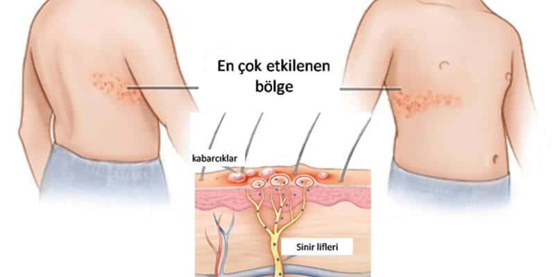 zona hastalığı