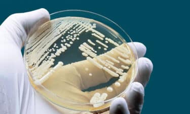 a hand holding a petri dish with white bacteria